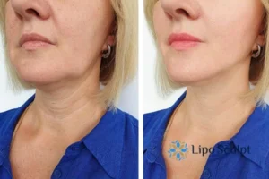 Double chin before and after Hi-Fu treatment 4 Book your double chin treatment Southampton today! We are here to help!