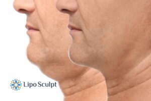 Double chin before and after Hi-Fu treatment 2 Double chin treatment Southampton from Lipo Sculpt - feel more confident today!