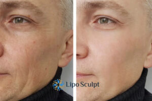 How to Fight Aging Symptoms 3 Fight Aging Symptoms Southampton With HIFU and Morpheus8 Today!