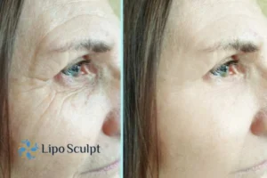 How to Fight Aging Symptoms 2 Do you want to Fight Aging Symptoms Southampton? Contact Lipo Sculpt today!