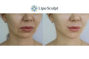 Explaining Total Skin Tightening Treatment And What It Can Do For You 2 Do you want to boost your self confidence? Give Morpheus8 Southampton a try today!