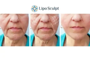 Explaining Total Skin Tightening Treatment And What It Can Do For You 3 Boost your confidence with Morpheus8 Southampton call our team today!