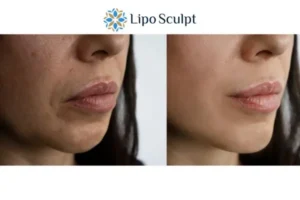 Explaining Total Skin Tightening Treatment And What It Can Do For You 4 Morpheus8 Southampton the best results - call our team today!