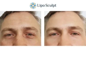 Explaining Total Skin Tightening Treatment And What It Can Do For You 6 Morpheus8 Southampton book in today to find out more!