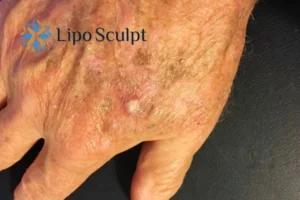 Best Actinic Keratoses Removal 2 Improve your wellbeing and health with Actinic Keratoses Southampton removal.treatment