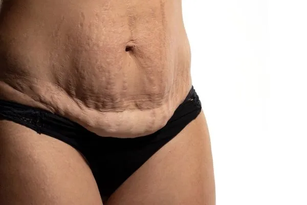 Lost the Weight but Not the Loose Skin? 1 image of womans stomach after weight loss showing loose skin Southampton